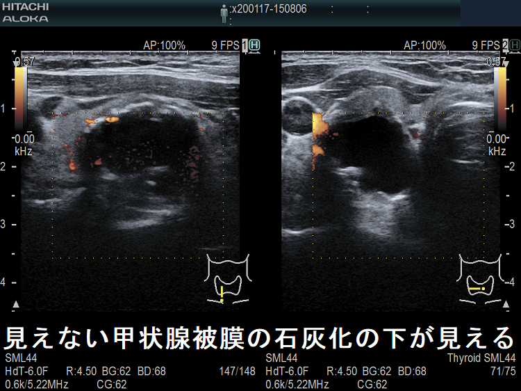 見えない甲状腺被膜の石灰化の下が見える ドプラーモード 見えない甲状腺被膜の石灰化の下が見える ドプラーモード