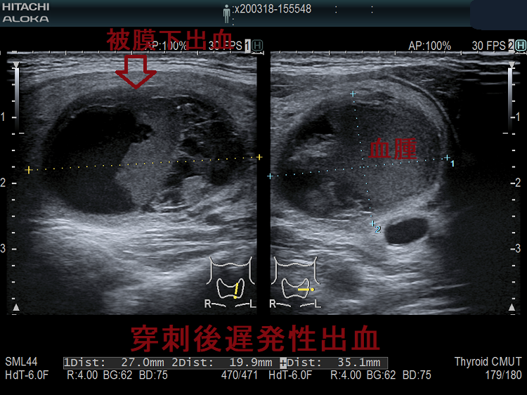 穿刺後遅発性出血 超音波(エコー)画像 穿刺後遅発性出血 超音波(エコー)画像
