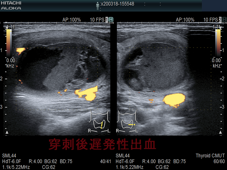 穿刺後遅発性出血 超音波(エコー)画像 ドプラーモード 穿刺後遅発性出血 超音波(エコー)画像 ドプラーモード