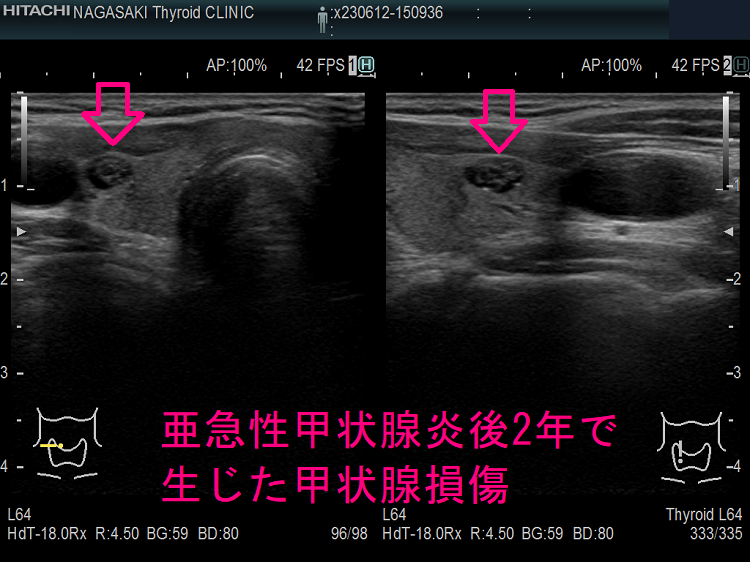 亜急性甲状腺炎後2年で生じた甲状腺損傷 超音波(エコー)画像 亜急性甲状腺炎後2年で生じた甲状腺損傷 超音波(エコー)画像
