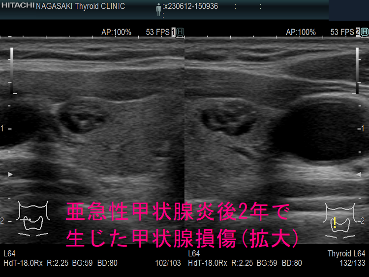 亜急性甲状腺炎後2年で生じた甲状腺損傷 超音波(エコー)画像 (拡大) 亜急性甲状腺炎後2年で生じた甲状腺損傷 超音波(エコー)画像 (拡大)