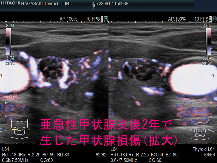 亜急性甲状腺炎後2年で生じた甲状腺損傷 超音波(エコー)画像 (拡大)ドプラーモード 亜急性甲状腺炎後2年で生じた甲状腺損傷 超音波(エコー)画像 (拡大)ドプラーモード