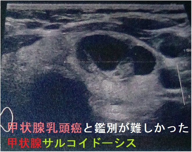 甲状腺乳頭癌と鑑別が難しかった甲状腺サルコイドーシス 超音波(エコー)画像 甲状腺乳頭癌と鑑別が難しかった甲状腺サルコイドーシス 超音波(エコー)画像