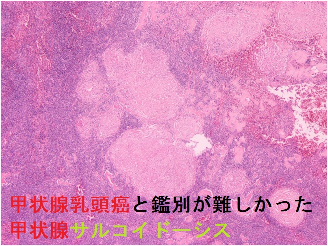 甲状腺乳頭癌と鑑別が難しかった甲状腺サルコイドーシス 組織像 甲状腺乳頭癌と鑑別が難しかった甲状腺サルコイドーシス 組織像