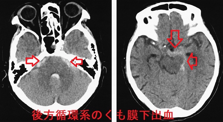 後方循環系のくも膜下出血 単純CT画像 後方循環系のくも膜下出血 単純CT画像