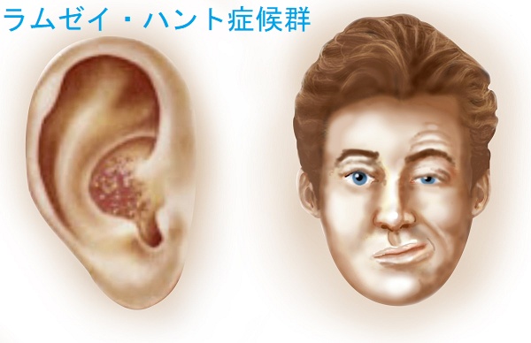 ラムゼイ・ハント症候群 ラムゼイ・ハント症候群