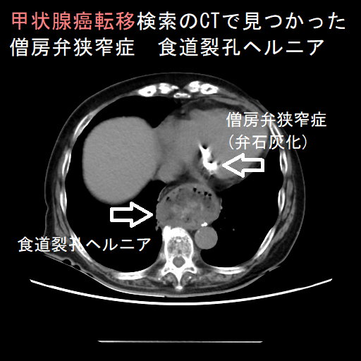 甲状腺癌転移検索のCTで見つかった僧房弁狭窄症 食道裂孔ヘルニア 甲状腺癌転移検索のCTで見つかった僧房弁狭窄症 食道裂孔ヘルニア