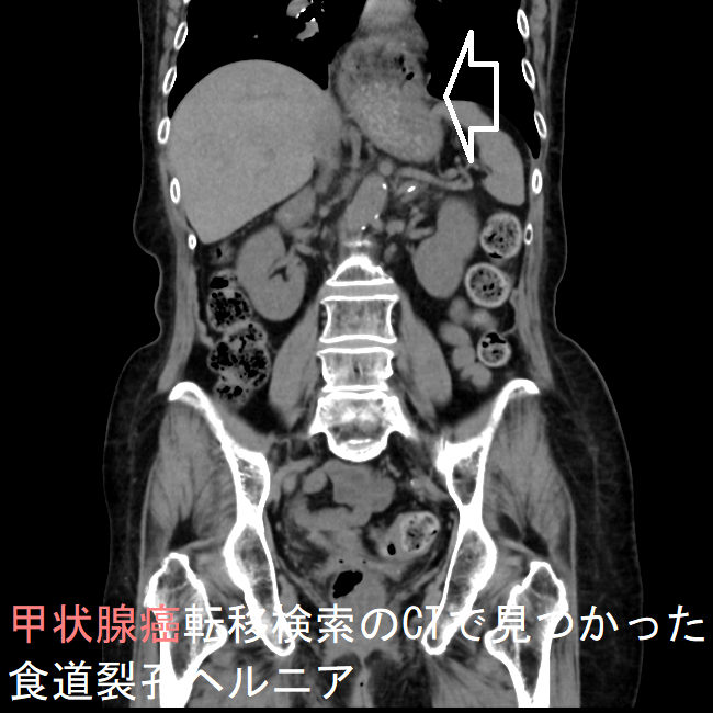 甲状腺癌転移検索のCTで見つかった 食道裂孔ヘルニア(冠状断) 甲状腺癌転移検索のCTで見つかった 食道裂孔ヘルニア(冠状断)