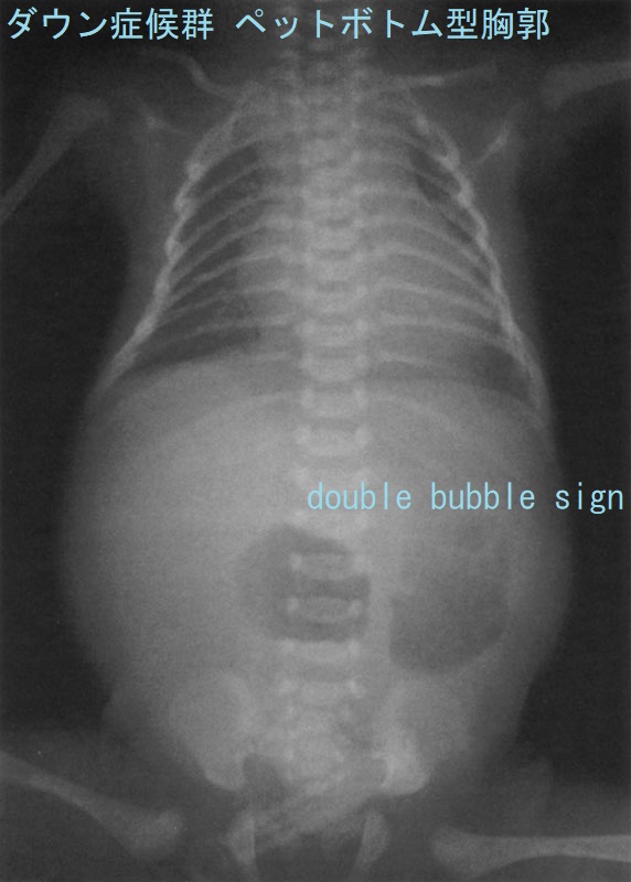 ダウン症候群 ペットボトム型胸郭・double bubble sign 胸腹部エックス線写真 ダウン症候群 ペットボトム型胸郭・double bubble sign 胸腹部エックス線写真