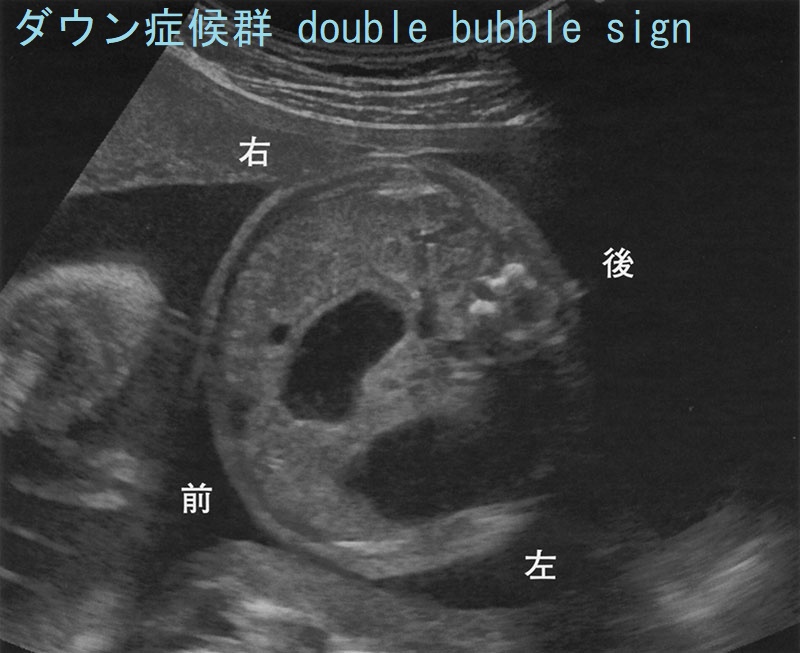 ダウン症候群 double bubble sign 胎児超音波像 ダウン症候群 double bubble sign 胎児超音波像
