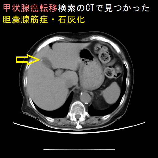 甲状腺癌転移検索のCTで見つかった胆嚢腺筋症・石灰化 甲状腺癌転移検索のCTで見つかった胆嚢腺筋症・石灰化