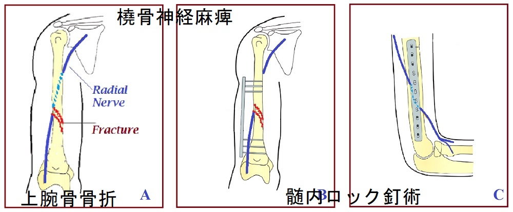 上腕骨骨折や髄内ロック釘術による橈骨神経麻痺 上腕骨骨折や髄内ロック釘術による橈骨神経麻痺