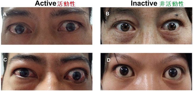 活動性・非活動性バセドウ病眼症(甲状腺眼症)比較 活動性・非活動性バセドウ病眼症(甲状腺眼症)比較
