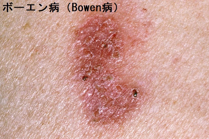 ボーエン病(Bowen病) ボーエン病(Bowen病)