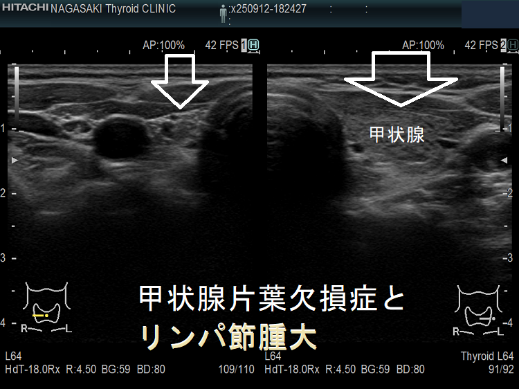 甲状腺片葉不完全欠損症(低形成)で腫大リンパ節が腫瘍のように見える(水平断) 甲状腺片葉不完全欠損症(低形成)で腫大リンパ節が腫瘍のように見える(水平断)