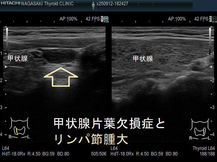 甲状腺片葉不完全欠損症(低形成)で腫大リンパ節が腫瘍のように見える(矢状断) 甲状腺片葉不完全欠損症(低形成)で腫大リンパ節が腫瘍のように見える(矢状断)