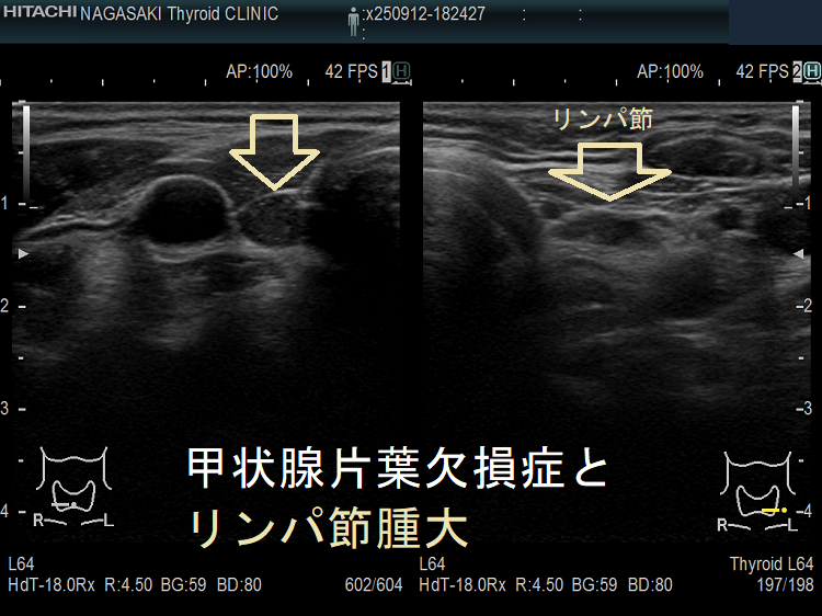 甲状腺片葉不完全欠損症(低形成)で腫大リンパ節が腫瘍のように見える(水平断)2 甲状腺片葉不完全欠損症(低形成)で腫大リンパ節が腫瘍のように見える(水平断)2