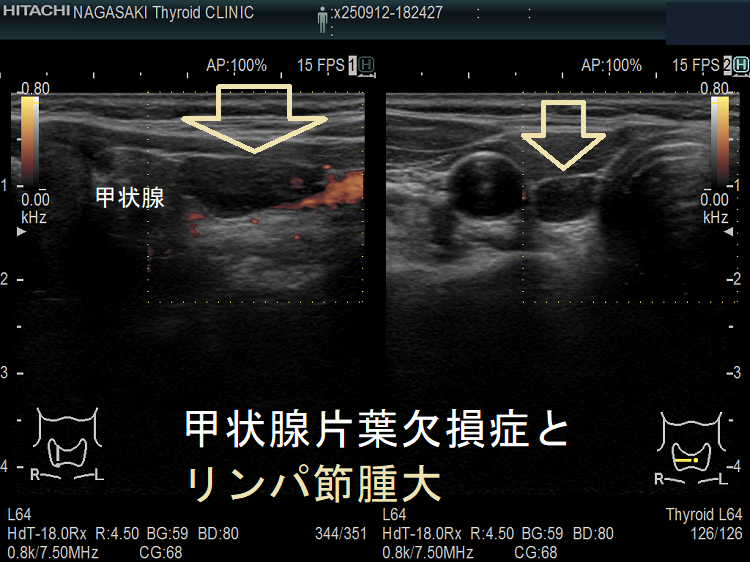 甲状腺片葉不完全欠損症(低形成)で腫大リンパ節が腫瘍のように見える 甲状腺片葉不完全欠損症(低形成)で腫大リンパ節が腫瘍のように見える