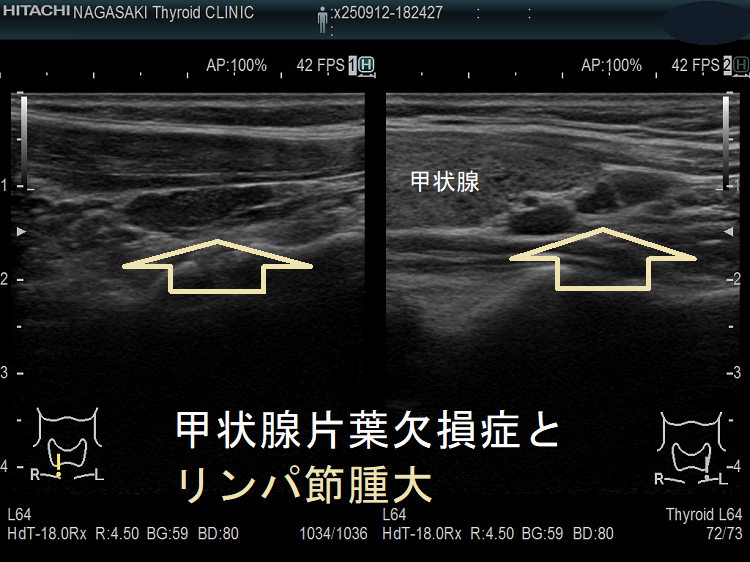 甲状腺片葉不完全欠損症(低形成)で腫大リンパ節が腫瘍のように見える(矢状断) 甲状腺片葉不完全欠損症(低形成)で腫大リンパ節が腫瘍のように見える(矢状断)