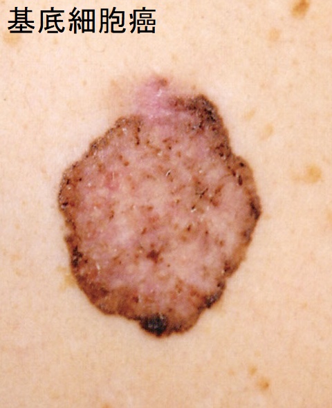 基底細胞癌 基底細胞癌2