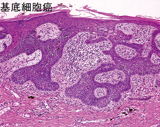 基底細胞癌 H-E 染色標本 基底細胞癌 H-E 染色標本
