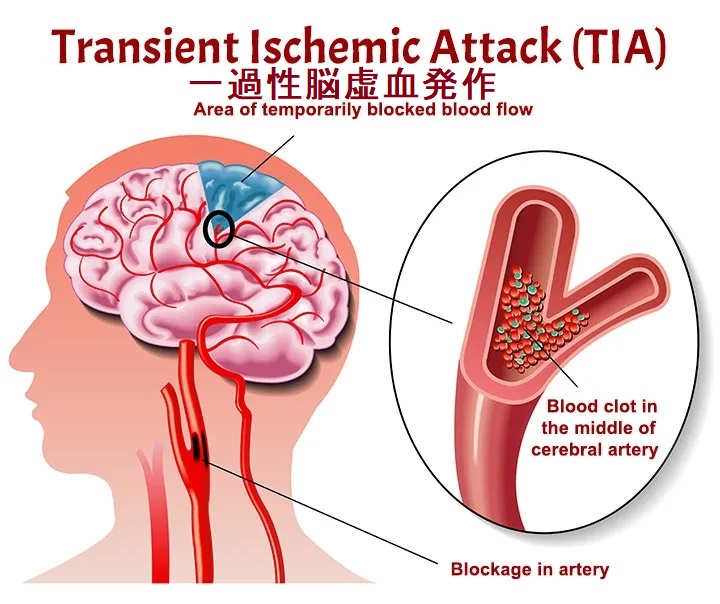 一過性脳虚血発作 (TIA) 一過性脳虚血発作 (TIA)