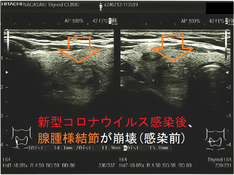 新型コロナウイルス感染(COVID-19)後、腺腫様結節が崩壊(感染前) 新型コロナウイルス感染(COVID-19)後、腺腫様結節が崩壊(感染前)