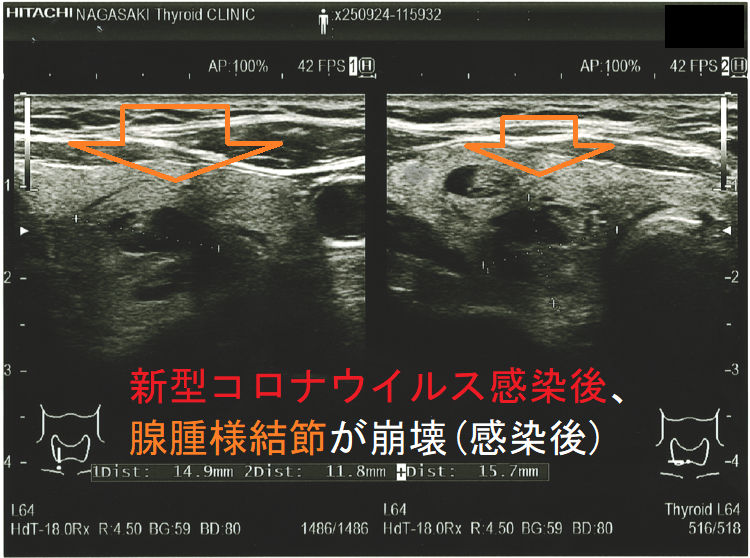 新型コロナウイルス感染(COVID-19)後、腺腫様結節が崩壊(感染後) 新型コロナウイルス感染(COVID-19)後、腺腫様結節が崩壊(感染後)