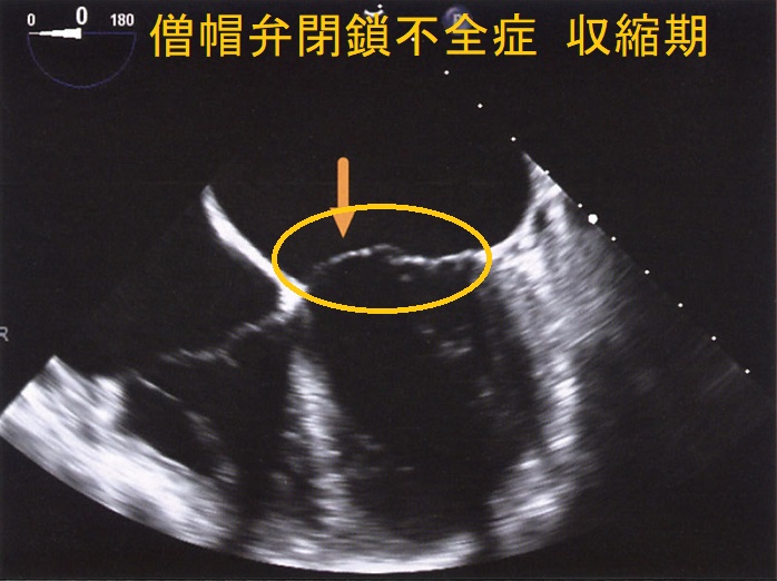 僧帽弁閉鎖不全症 収縮期 経食道心エコー図 僧帽弁閉鎖不全症 収縮期 経食道心エコー図