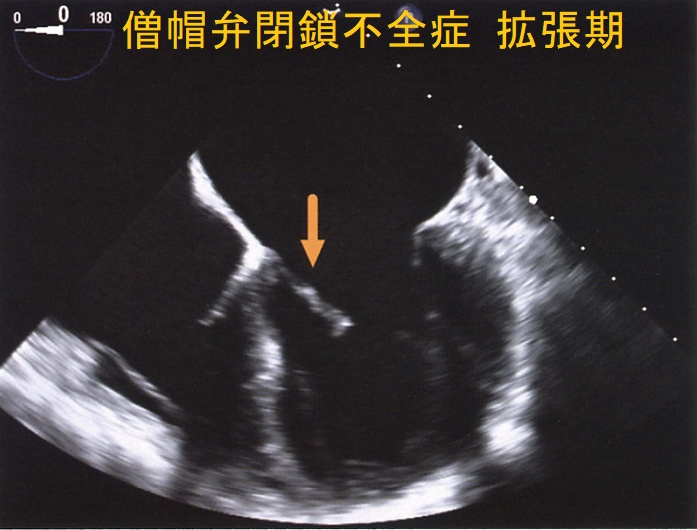 僧帽弁閉鎖不全症 拡張期 経食道心エコー図 僧帽弁閉鎖不全症 拡張期 経食道心エコー図
