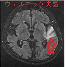 ウェルニッケ失語 頭部単純MRI FLAIR像 ウェルニッケ失語 頭部単純MRI FLAIR像