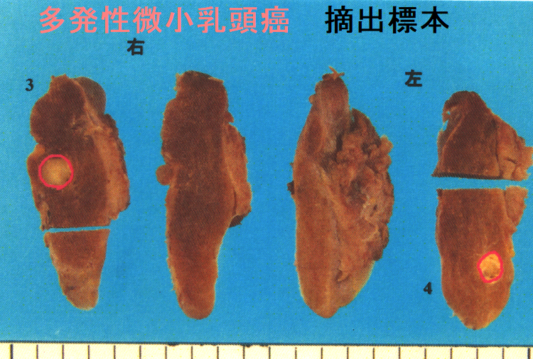 両葉多発性の甲状腺微小乳頭癌 摘出標本 両葉多発性の甲状腺微小乳頭癌 摘出標本