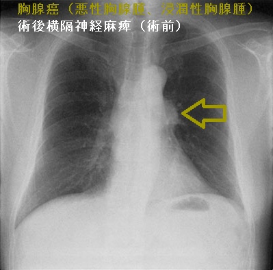 胸腺癌(悪性胸腺腫、浸潤性胸腺腫)術後横隔神経麻痺(術前) 胸腺癌(悪性胸腺腫、浸潤性胸腺腫)術後横隔神経麻痺(術前)
