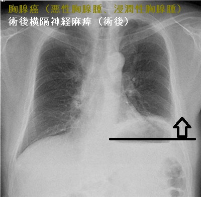 胸腺癌(悪性胸腺腫、浸潤性胸腺腫)術後横隔神経麻痺(術後) 胸腺癌(悪性胸腺腫、浸潤性胸腺腫)術後横隔神経麻痺(術後)