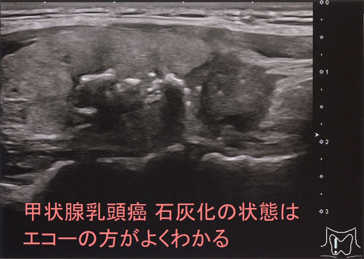甲状腺乳頭癌 石灰化の状態はエコーの方がよくわかる 甲状腺乳頭癌 石灰化の状態はエコーの方がよくわかる
