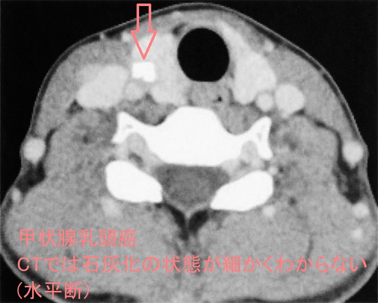 甲状腺乳頭癌 CTでは石灰化の状態が細かくわからない(水平断) 甲状腺乳頭癌 CTでは石灰化の状態が細かくわからない(水平断)