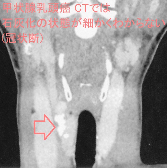 甲状腺乳頭癌 CTでは石灰化の状態が細かくわからない(冠状断) 甲状腺乳頭癌 CTでは石灰化の状態が細かくわからない(冠状断)
