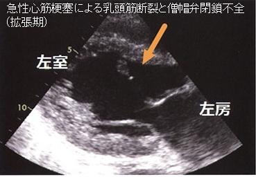 急性心筋梗塞による乳頭筋断裂と僧帽弁閉鎖不全症(拡張期) 急性心筋梗塞による乳頭筋断裂と僧帽弁閉鎖不全症(拡張期)