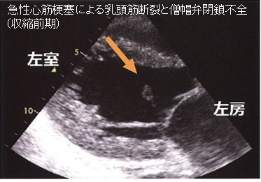 急性心筋梗塞による乳頭筋断裂と僧帽弁閉鎖不全症(収縮前期) 急性心筋梗塞による乳頭筋断裂と僧帽弁閉鎖不全症(収縮前期)