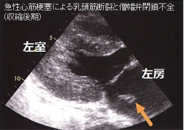 急性心筋梗塞による乳頭筋断裂と僧帽弁閉鎖不全症(収縮後期) 急性心筋梗塞による乳頭筋断裂と僧帽弁閉鎖不全症(収縮後期)