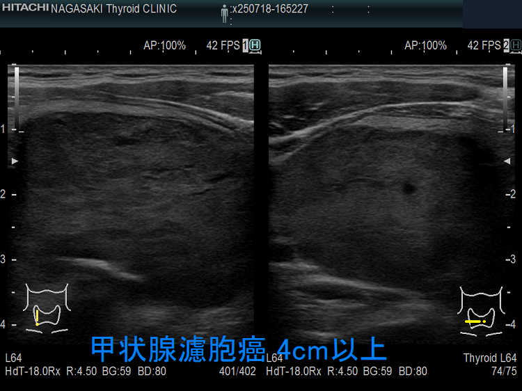 4cm以上の巨大甲状腺濾胞癌 4cm以上の巨大甲状腺濾胞癌
