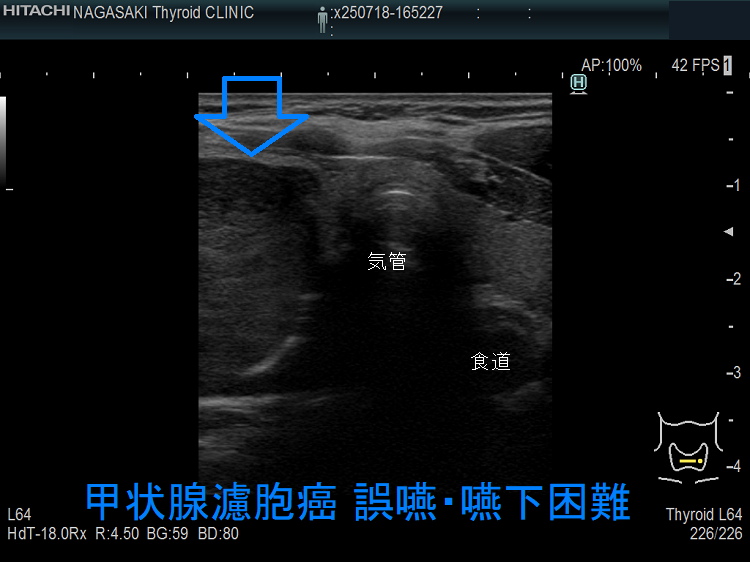 甲状腺濾胞癌 誤嚥・嚥下困難 甲状腺濾胞癌 誤嚥・嚥下困難