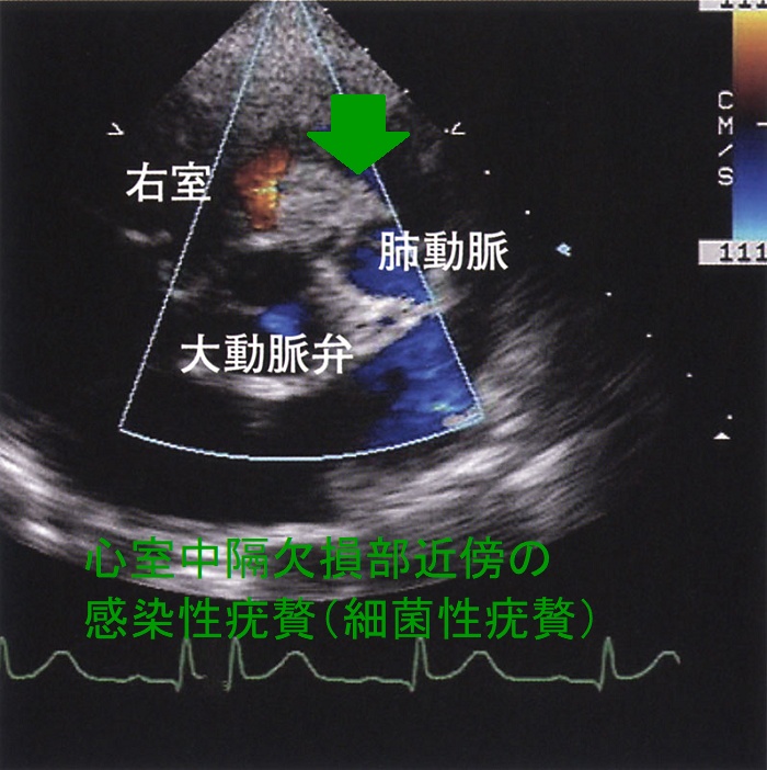 心室中隔欠損部近傍の感染性疣贅(細菌性疣贅) 心室中隔欠損部近傍の感染性疣贅(細菌性疣贅)