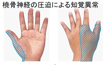 橈骨神経の圧迫による知覚異常 橈骨神経の圧迫による知覚異常