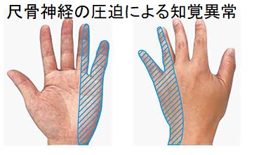 尺骨神経の圧迫による知覚異常 尺骨神経の圧迫による知覚異常