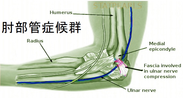 肘部管症候群 肘部管症候群