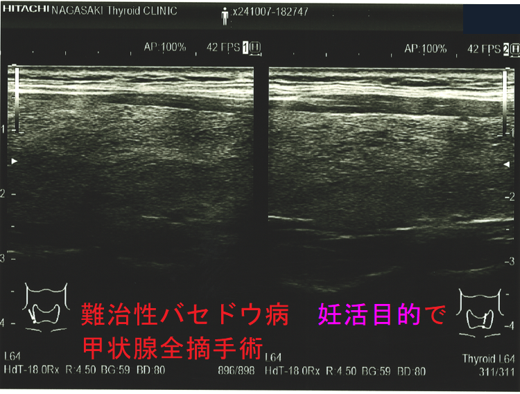 難治性バセドウ病 妊活目的で甲状腺全摘手術標本(矢状断) 難治性バセドウ病 妊活目的で甲状腺全摘手術標本(矢状断)