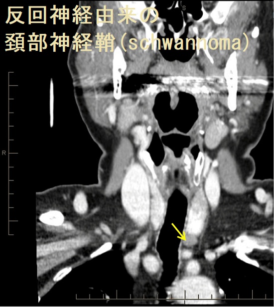反回神経由来の頚部神経鞘腫(schwannoma) 反回神経由来の頚部神経鞘腫(schwannoma)