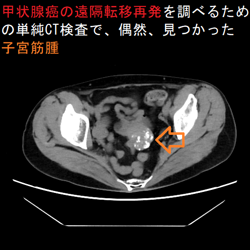 甲状腺癌の遠隔転移再発を調べるための単純CT検査で、偶然、見つかった子宮筋腫 甲状腺癌の遠隔転移再発を調べるための単純CT検査で、偶然、見つかった子宮筋腫