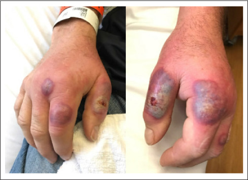 橋本病(慢性甲状腺炎)に合併したSweet症候群 橋本病(慢性甲状腺炎)に合併したSweet症候群